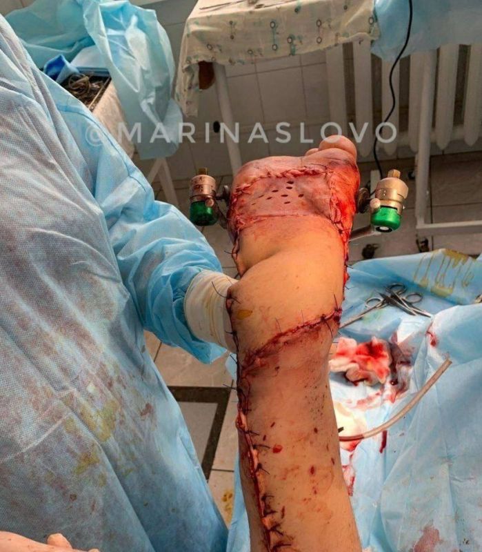 В Донецке мальчику, который наступил на мину «Лепесток», восстановили ногу