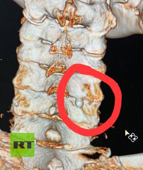 Эксклюзив RT. Дмитрий Рогозин предоставил RT фото извлечённого из его спины осколка от гаубицы CAESAR — он отправил его послу Франции в России