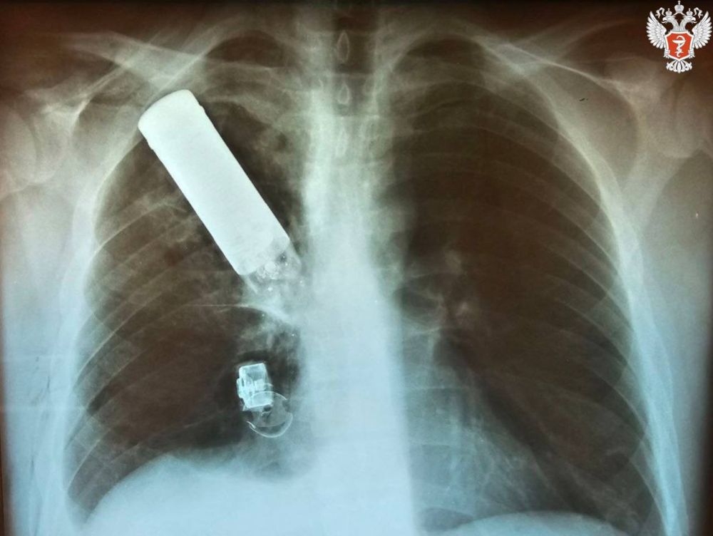 Донецкие врачи спасли пациента с осколком гранаты в груди