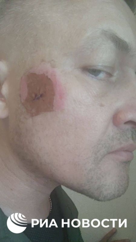 Советник главы ДНР Ян Гагин заявил, что ВСУ сбросили на него боеприпас с токсичным веществом!