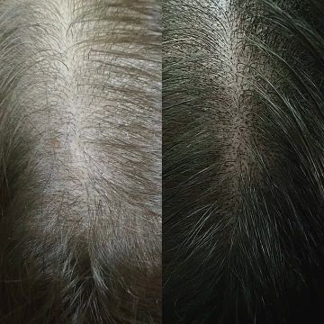 Трихопигментация для женского эстетического загущения волос