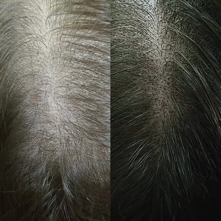 Трихопигментация для женского эстетического загущения волос